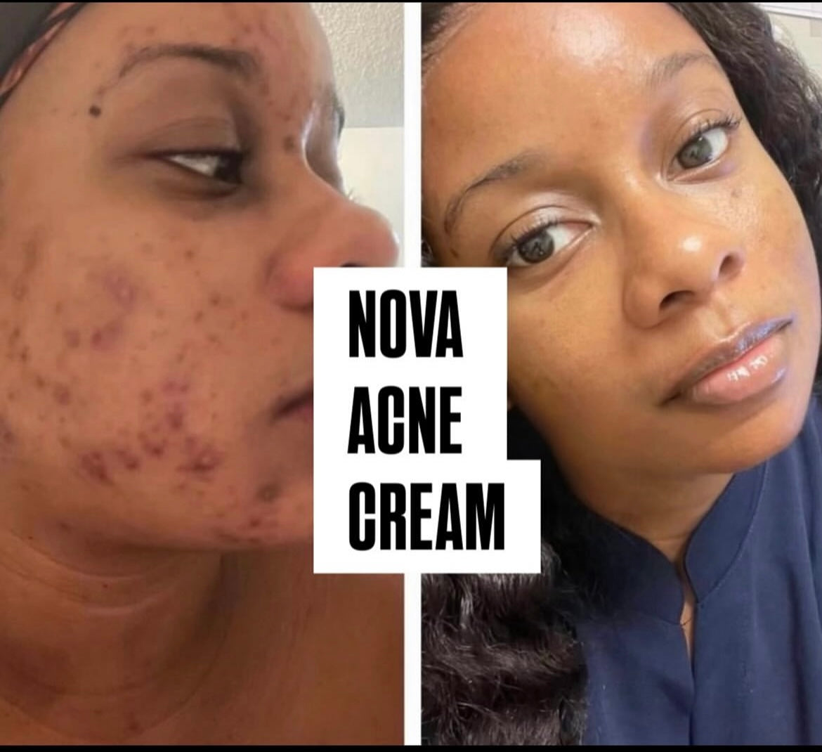 NOVA ACNE CREAM